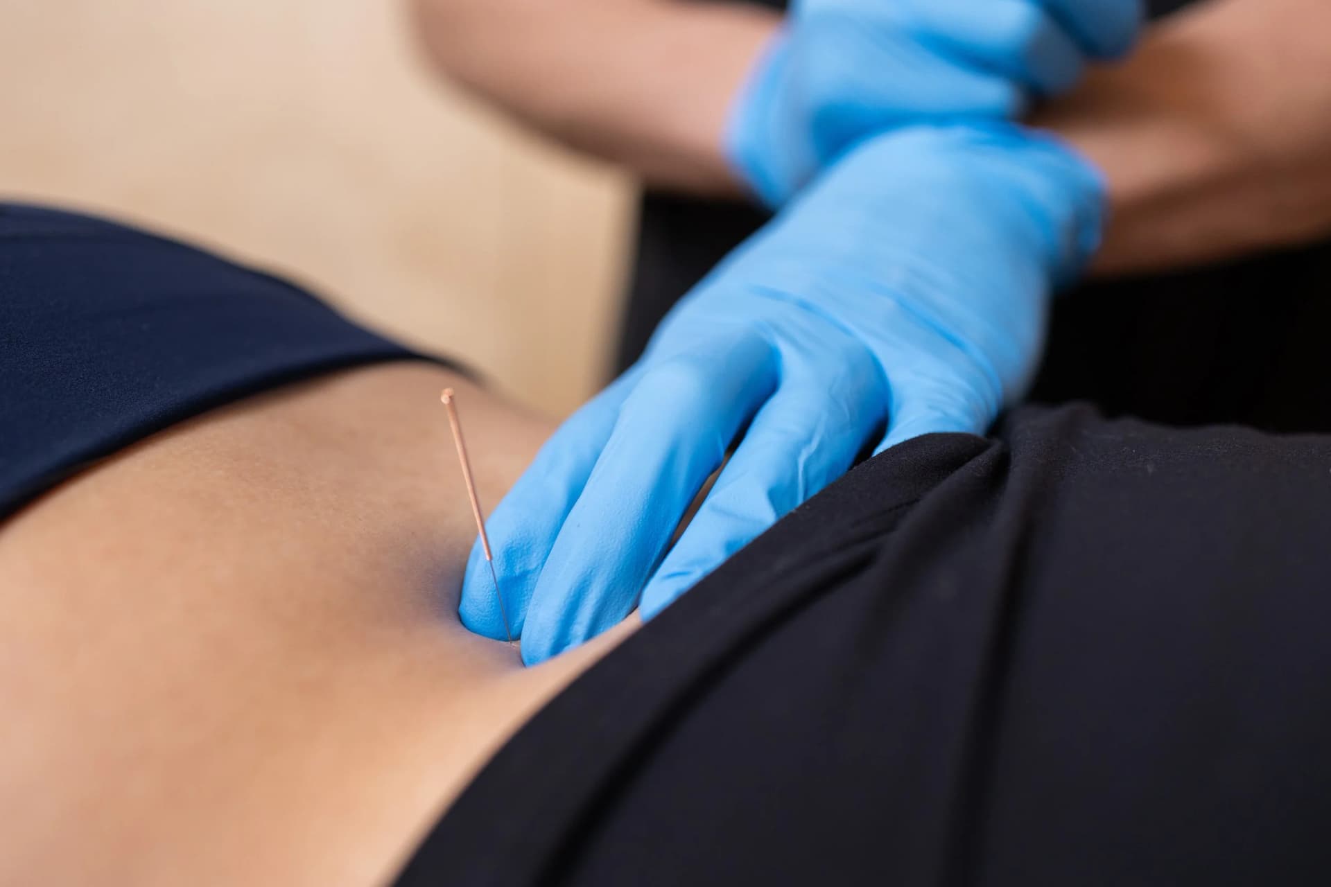 A clinician wearing blue gloves inserts a fine dry needle into a patient's lower back.